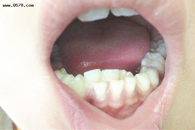 门牙中间长了一颗小牙齿相学 宝宝先长虎牙算命:宝宝上面先长虎牙，正常吗？